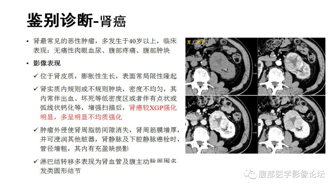 影像PPT - 【病例】肾脏黄色肉芽肿性肾盂肾炎1例CT及MR影像诊断-23