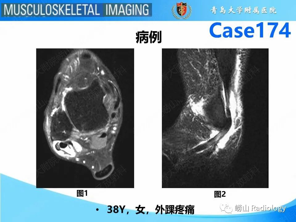 影像PPT - 【PPT】腓骨短肌腱撕裂-2