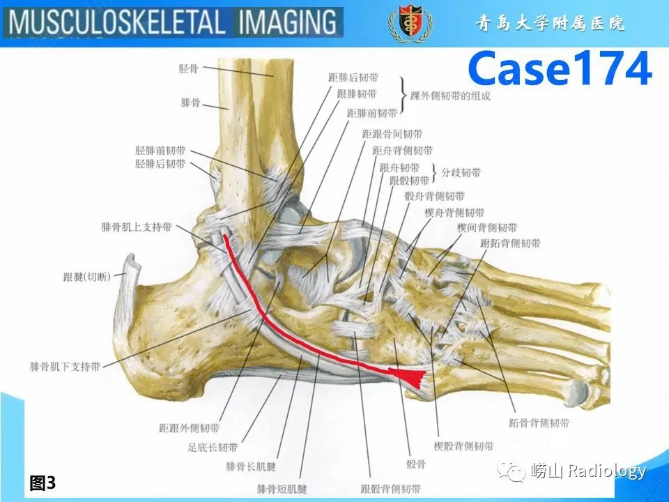 影像PPT - 【PPT】腓骨短肌腱撕裂-6