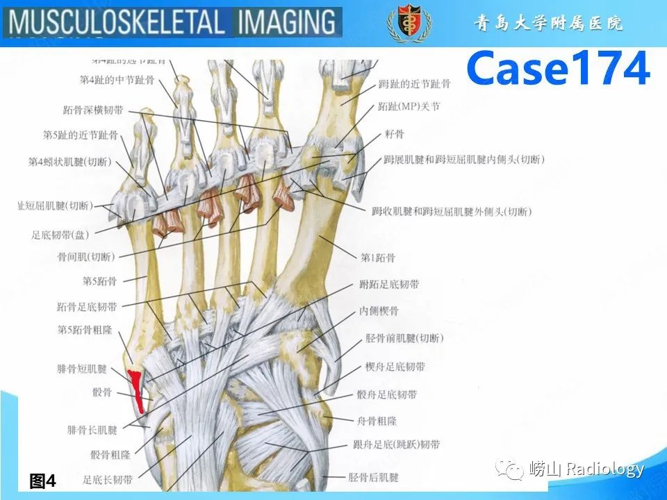 影像PPT - 【PPT】腓骨短肌腱撕裂-7