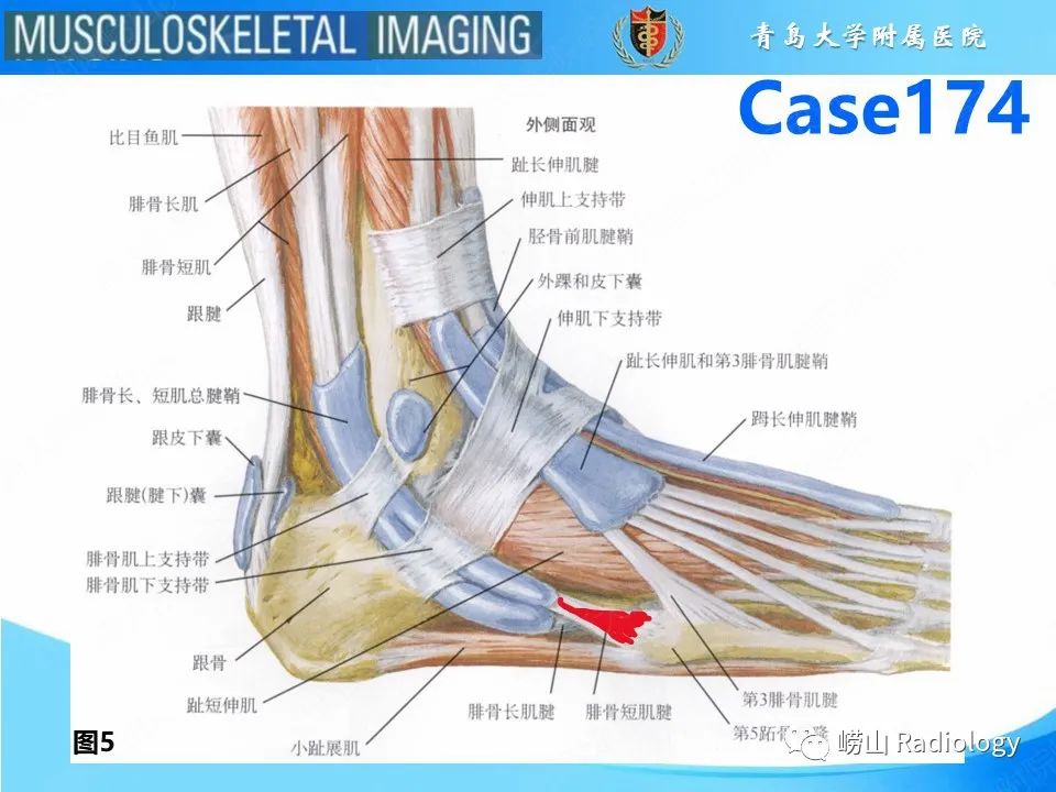 影像PPT - 【PPT】腓骨短肌腱撕裂-8