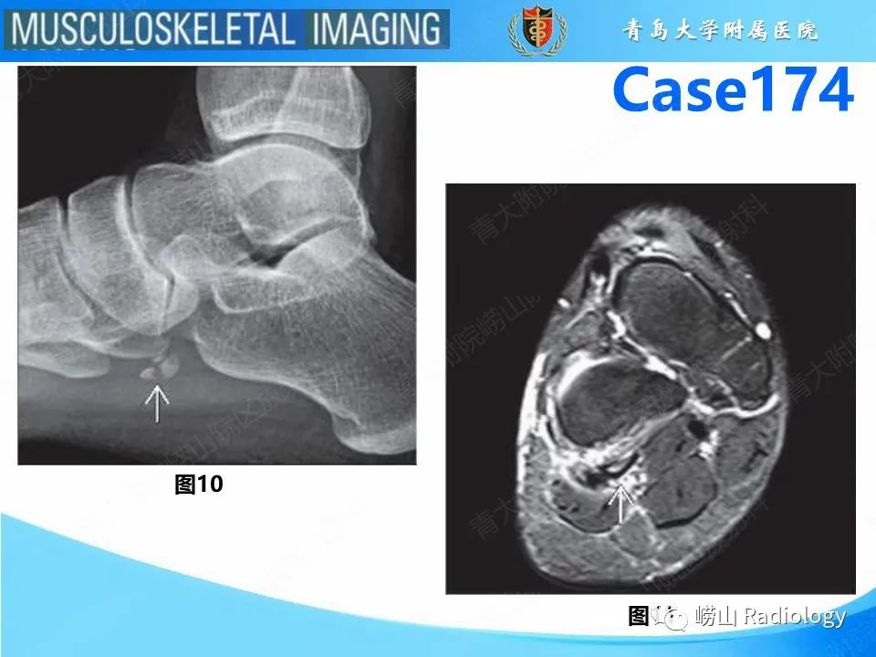 影像PPT - 【PPT】腓骨短肌腱撕裂-13