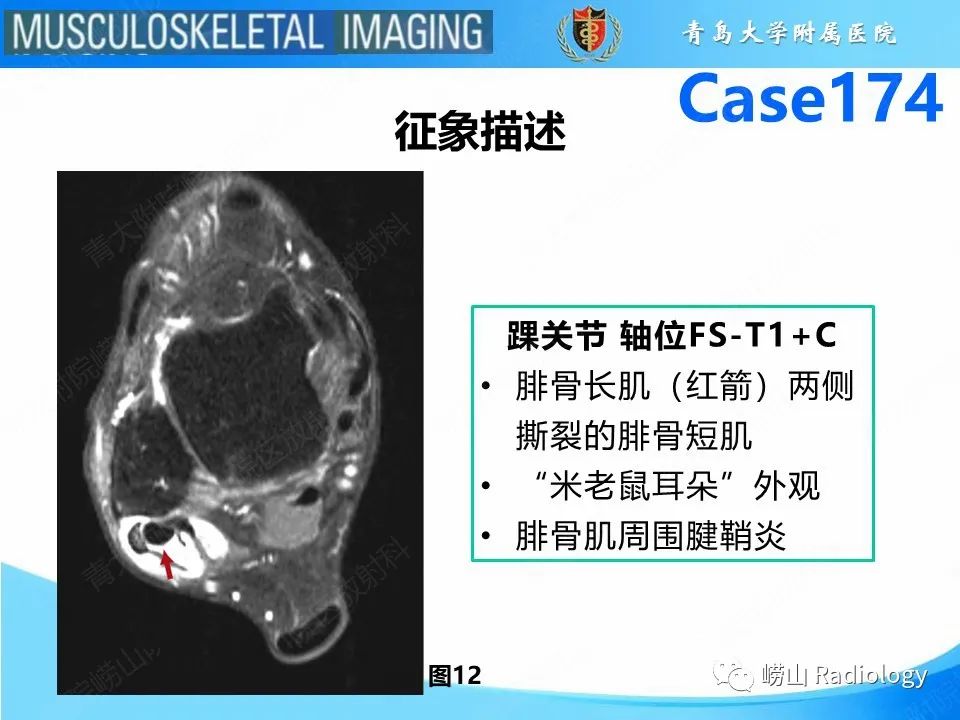 影像PPT - 【PPT】腓骨短肌腱撕裂-20