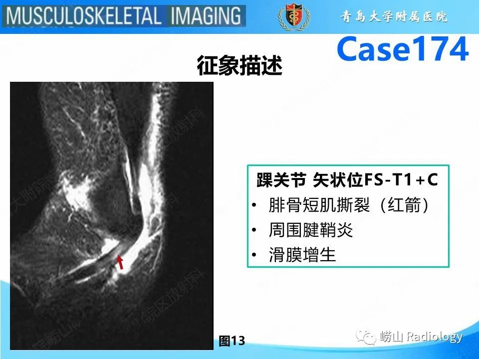 影像PPT - 【PPT】腓骨短肌腱撕裂-21