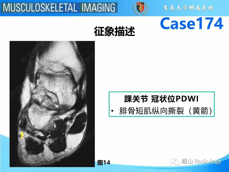 影像PPT - 【PPT】腓骨短肌腱撕裂-22