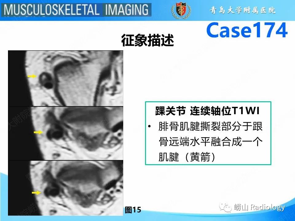 影像PPT - 【PPT】腓骨短肌腱撕裂-23