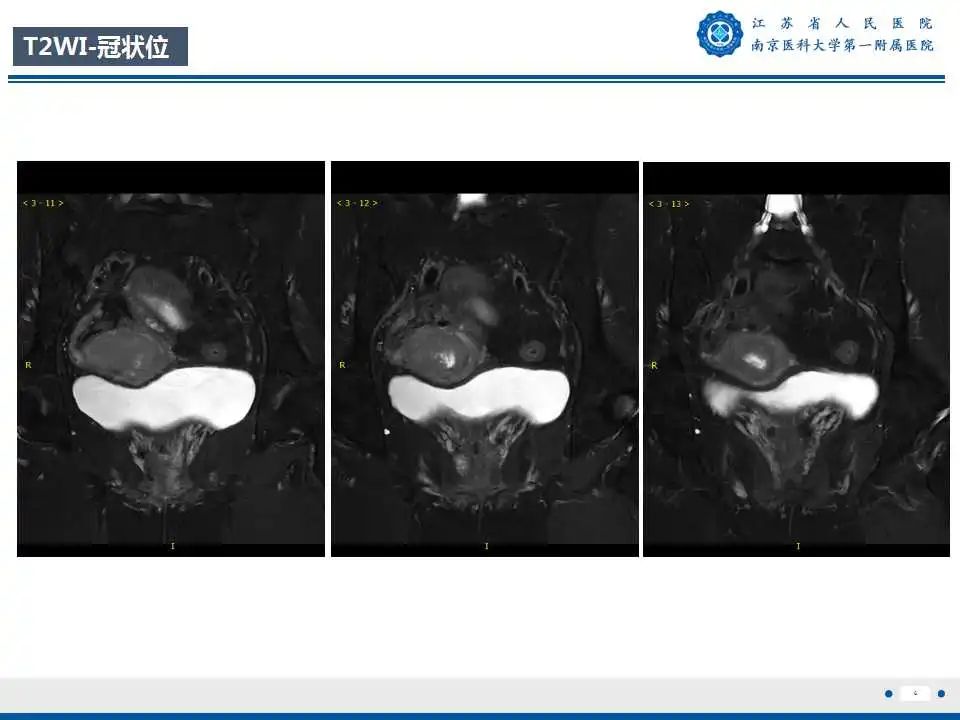 影像PPT - 【PPT】子宫内膜癌-6