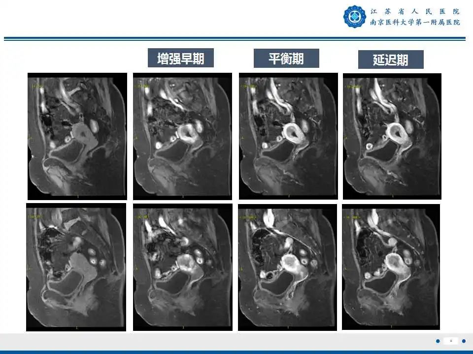 影像PPT - 【PPT】子宫内膜癌-8