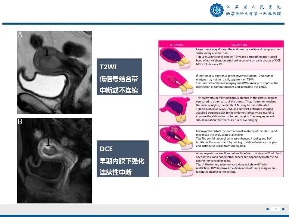 影像PPT - 【PPT】子宫内膜癌-18