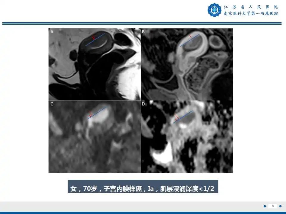 影像PPT - 【PPT】子宫内膜癌-19