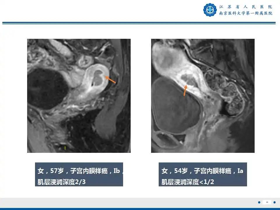 影像PPT - 【PPT】子宫内膜癌-20