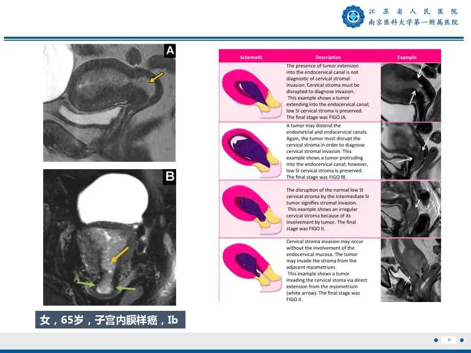 影像PPT - 【PPT】子宫内膜癌-27