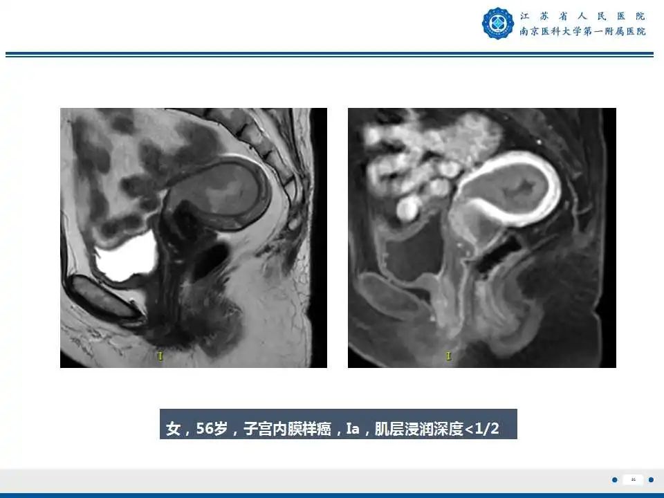 影像PPT - 【PPT】子宫内膜癌-26