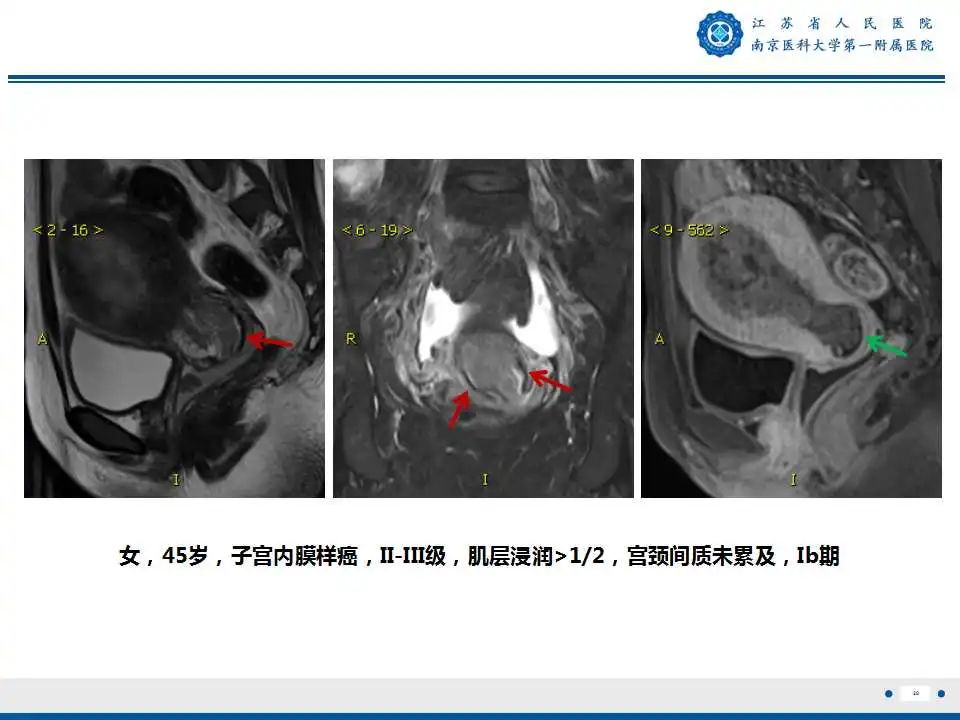影像PPT - 【PPT】子宫内膜癌-28