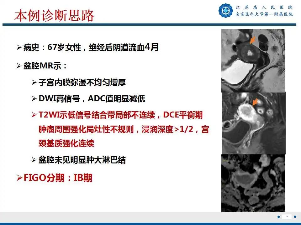 影像PPT - 【PPT】子宫内膜癌-30