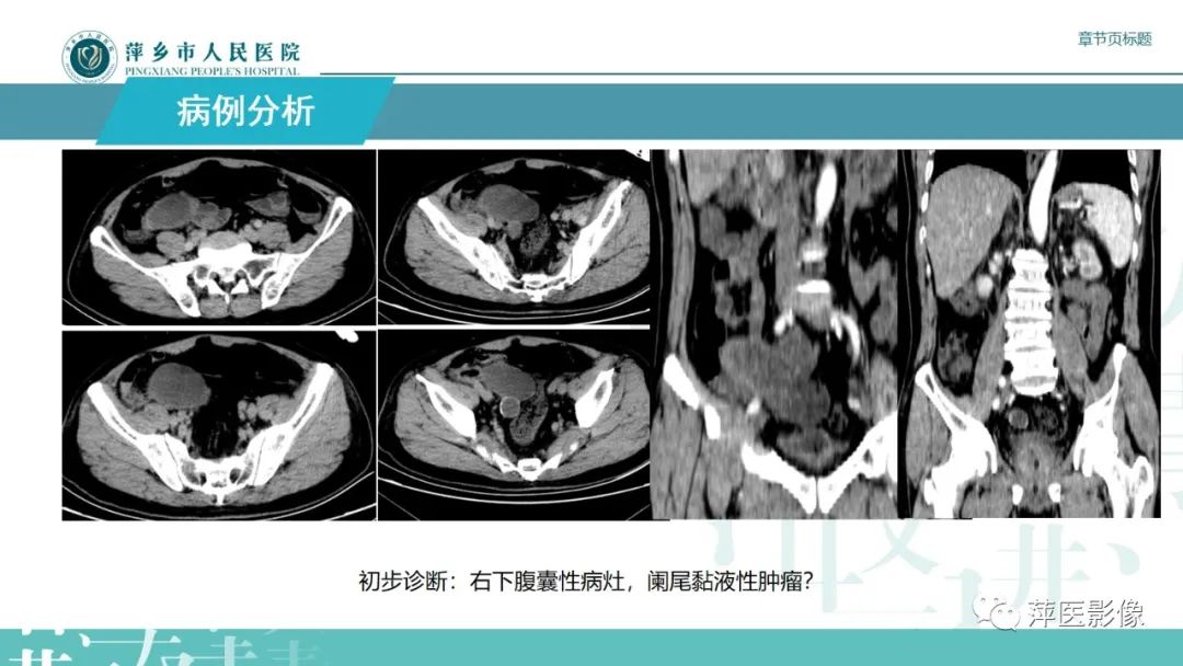 影像PPT - 【PPT】阑尾低级别黏液性肿瘤的CT诊断-5