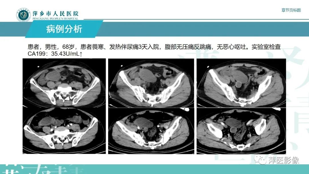 影像PPT - 【PPT】阑尾低级别黏液性肿瘤的CT诊断-4