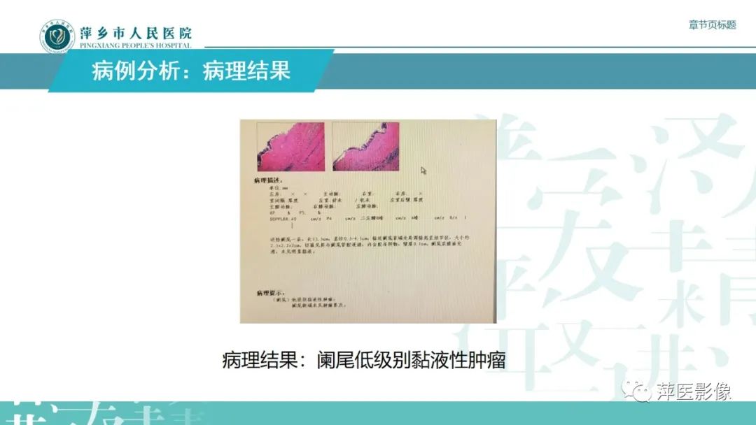 影像PPT - 【PPT】阑尾低级别黏液性肿瘤的CT诊断-6