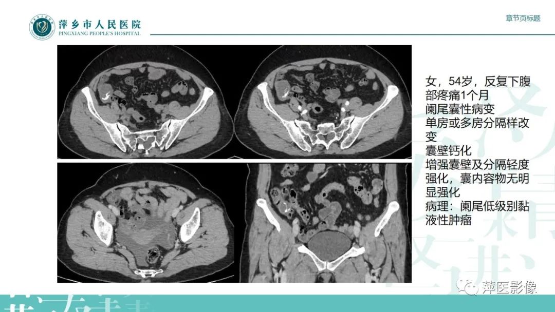 影像PPT - 【PPT】阑尾低级别黏液性肿瘤的CT诊断-15