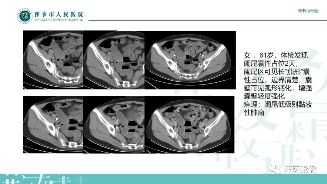 影像PPT - 【PPT】阑尾低级别黏液性肿瘤的CT诊断-16