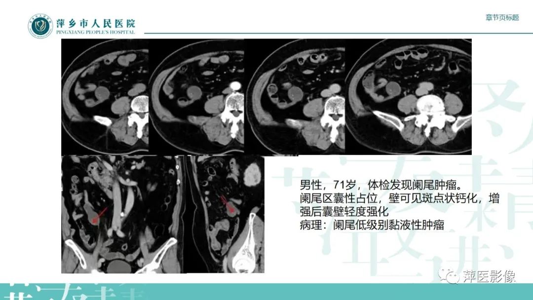 影像PPT - 【PPT】阑尾低级别黏液性肿瘤的CT诊断-17