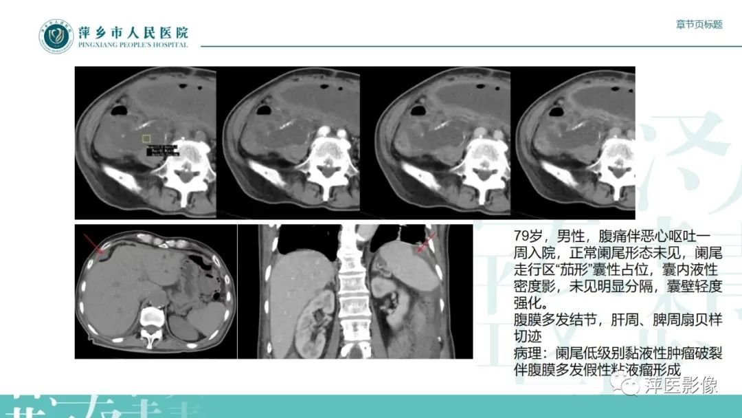 影像PPT - 【PPT】阑尾低级别黏液性肿瘤的CT诊断-18
