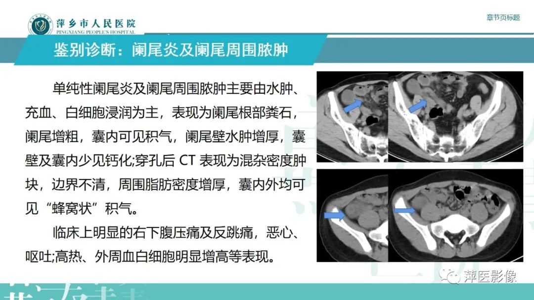 影像PPT - 【PPT】阑尾低级别黏液性肿瘤的CT诊断-20