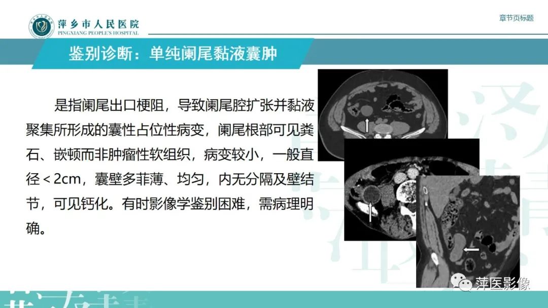 影像PPT - 【PPT】阑尾低级别黏液性肿瘤的CT诊断-21