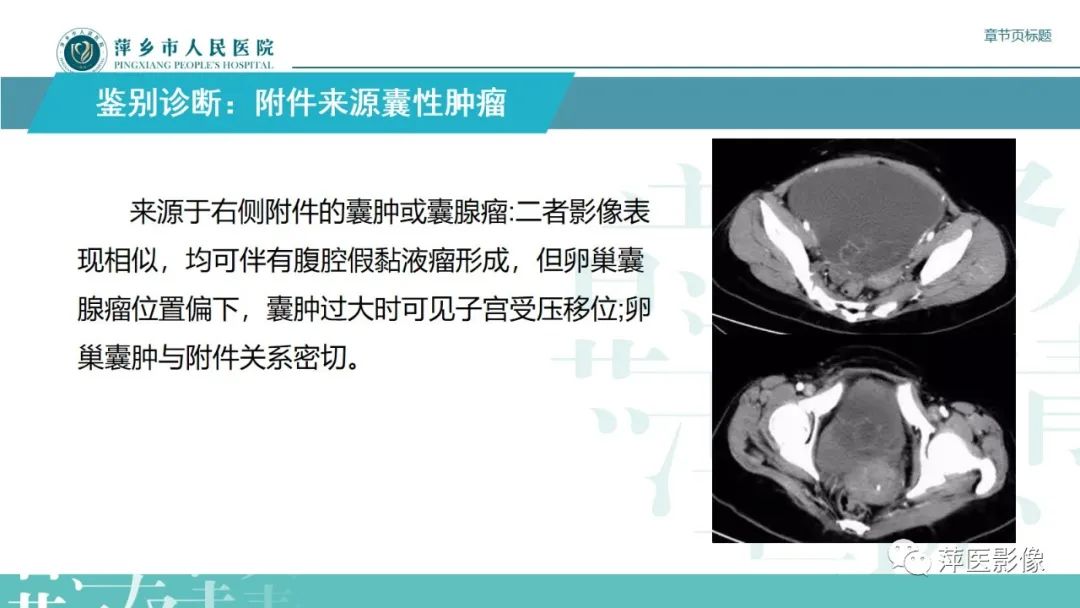 影像PPT - 【PPT】阑尾低级别黏液性肿瘤的CT诊断-22