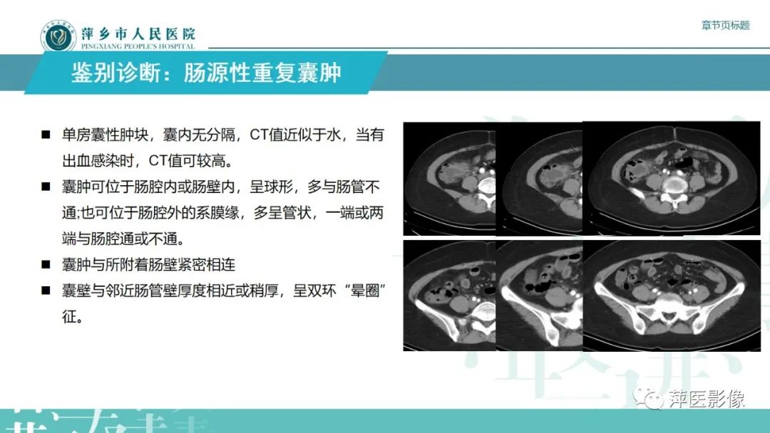 影像PPT - 【PPT】阑尾低级别黏液性肿瘤的CT诊断-23