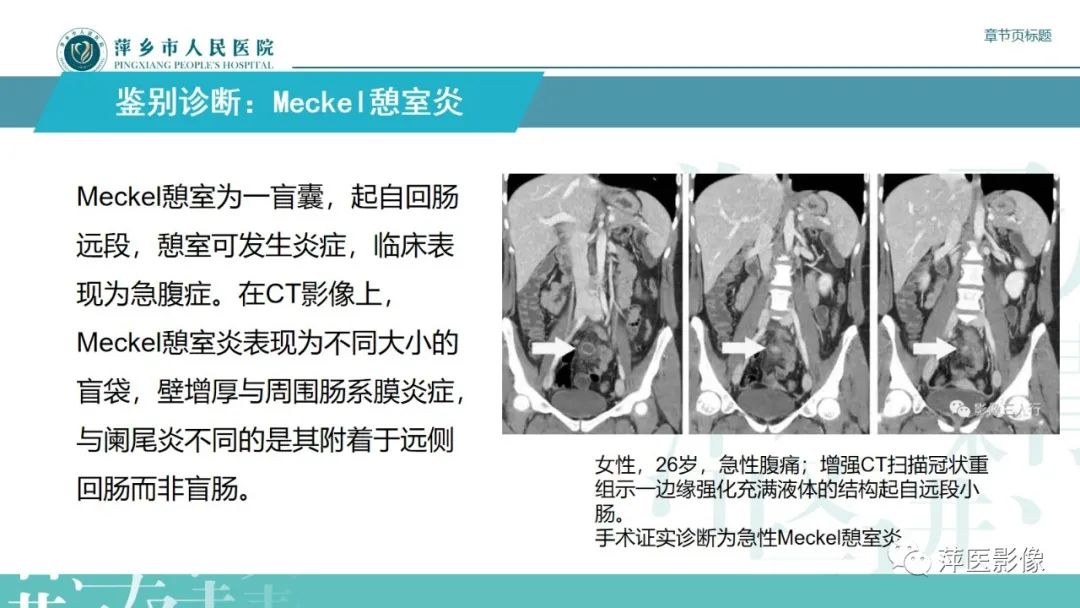 影像PPT - 【PPT】阑尾低级别黏液性肿瘤的CT诊断-24