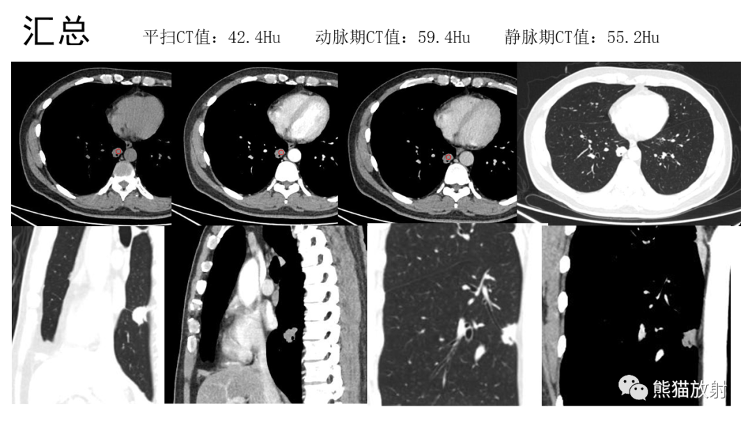影像PPT - 【病例】肺神经内分泌肿瘤2例CT影像-5