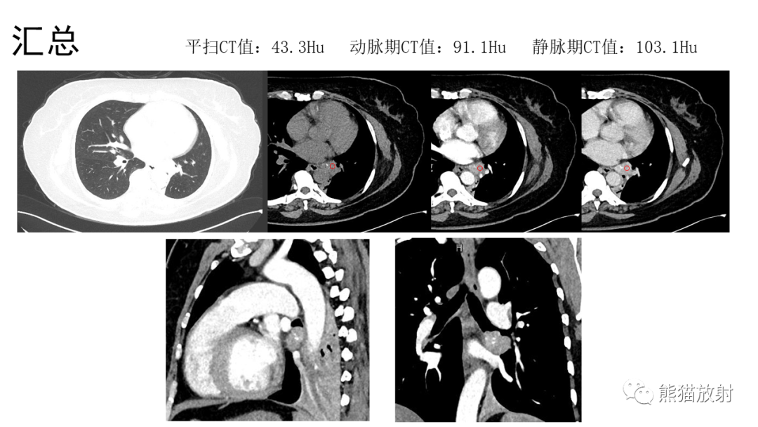 影像PPT - 【病例】肺神经内分泌肿瘤2例CT影像-13