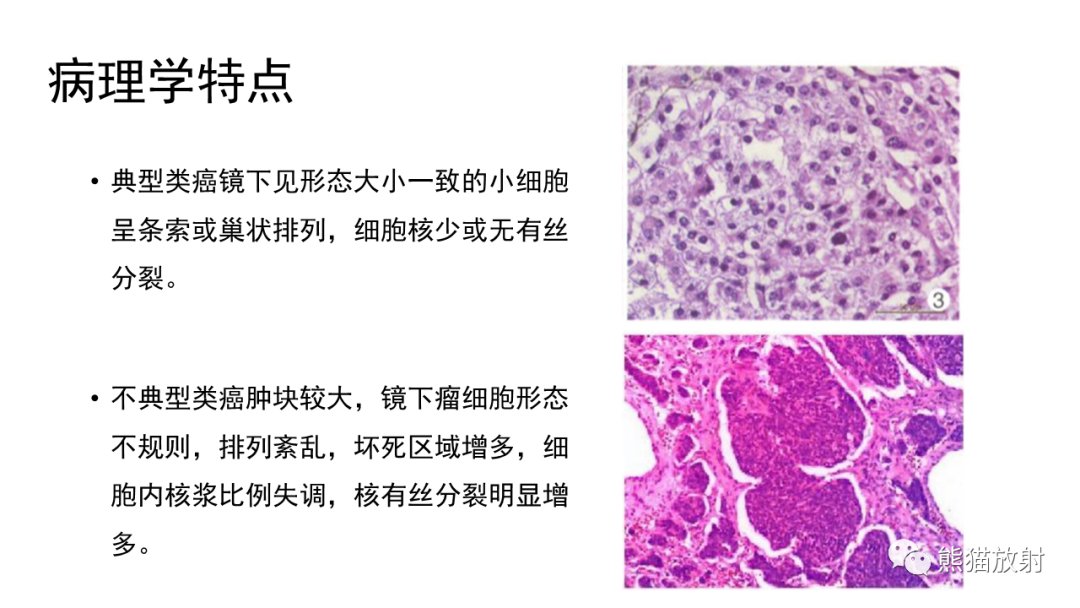 影像PPT - 【病例】肺神经内分泌肿瘤2例CT影像-20