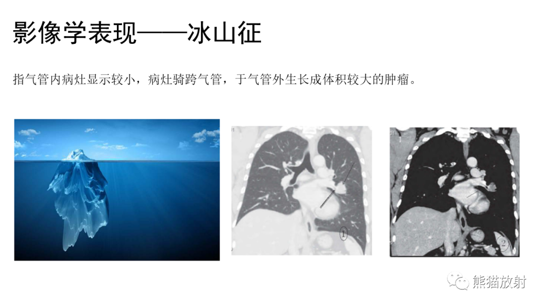 影像PPT - 【病例】肺神经内分泌肿瘤2例CT影像-23