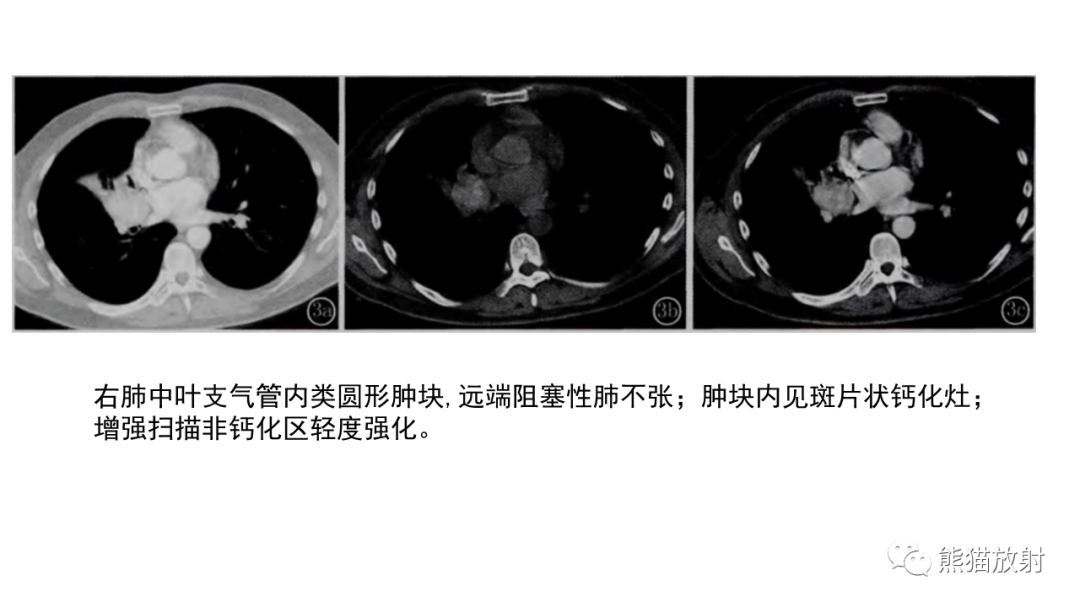 影像PPT - 【病例】肺神经内分泌肿瘤2例CT影像-29