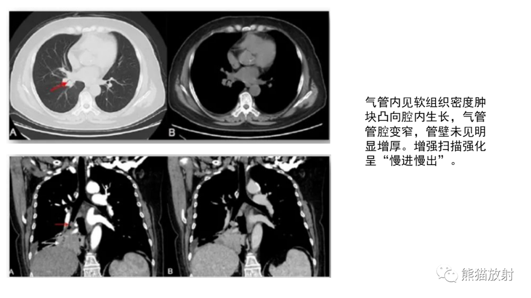 影像PPT - 【病例】肺神经内分泌肿瘤2例CT影像-32