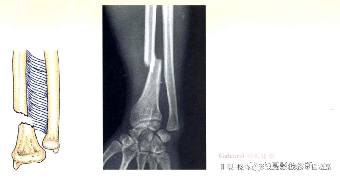 影像PPT - 盖氏骨折分型-3 影像PPT - 盖氏骨折分型-3