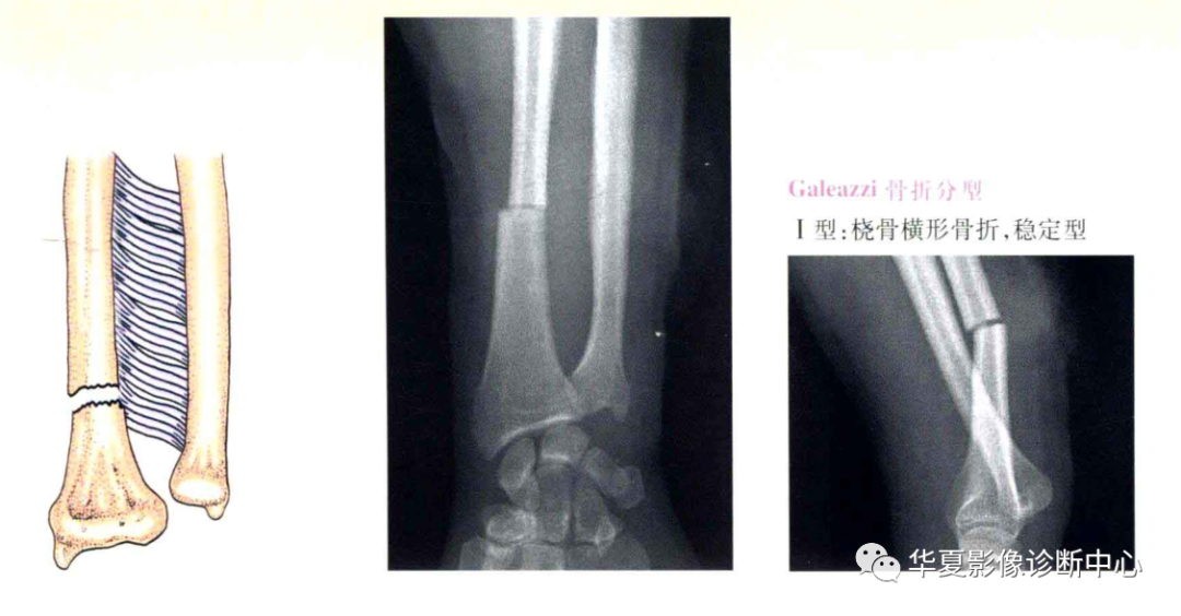 影像PPT - 盖氏骨折分型-2 影像PPT - 盖氏骨折分型-2