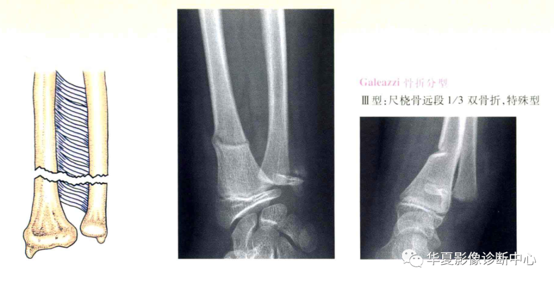 影像PPT - 盖氏骨折分型-4 影像PPT - 盖氏骨折分型-4