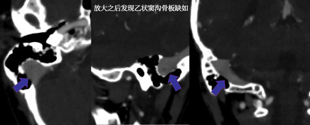 影像PPT - 【病例】乙状窦沟骨板缺损致搏动性耳鸣1例CT特征分析-2 影像PPT - 【病例】乙状窦沟骨板缺损致搏动性耳鸣1例CT特征分析-2