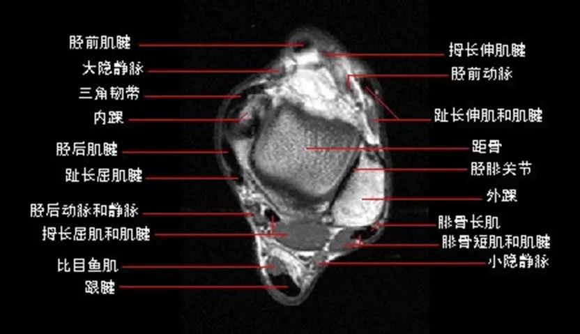 影像PPT - 踝关节MRI解剖及7种常见损伤类型影像表现-4 影像PPT - 踝关节MRI解剖及7种常见损伤类型影像表现-4