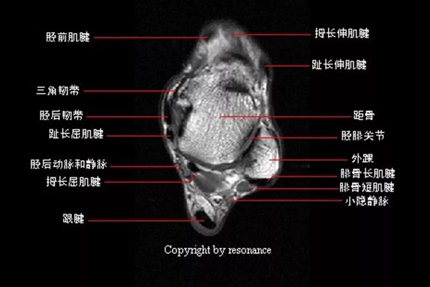 影像PPT - 踝关节MRI解剖及7种常见损伤类型影像表现-5 影像PPT - 踝关节MRI解剖及7种常见损伤类型影像表现-5