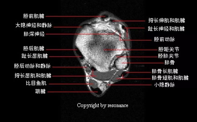 影像PPT - 踝关节MRI解剖及7种常见损伤类型影像表现-3 影像PPT - 踝关节MRI解剖及7种常见损伤类型影像表现-3