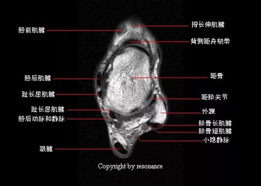 影像PPT - 踝关节MRI解剖及7种常见损伤类型影像表现-6 影像PPT - 踝关节MRI解剖及7种常见损伤类型影像表现-6