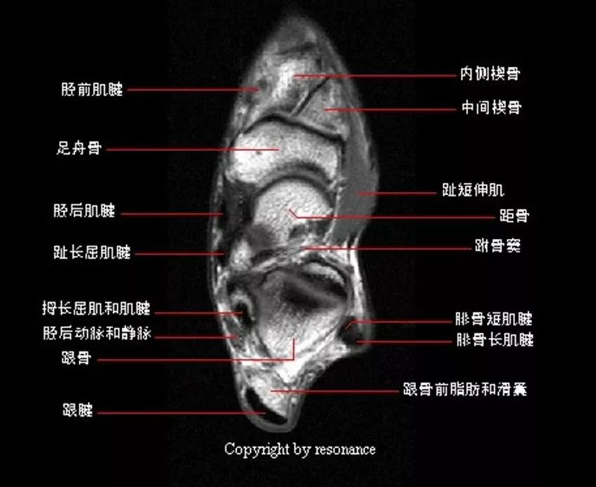 影像PPT - 踝关节MRI解剖及7种常见损伤类型影像表现-7 影像PPT - 踝关节MRI解剖及7种常见损伤类型影像表现-7
