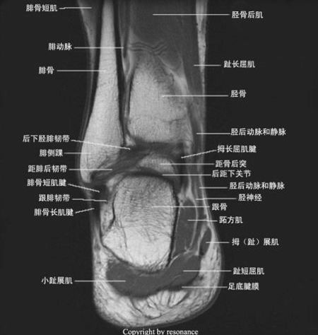 影像PPT - 踝关节MRI解剖及7种常见损伤类型影像表现-9 影像PPT - 踝关节MRI解剖及7种常见损伤类型影像表现-9