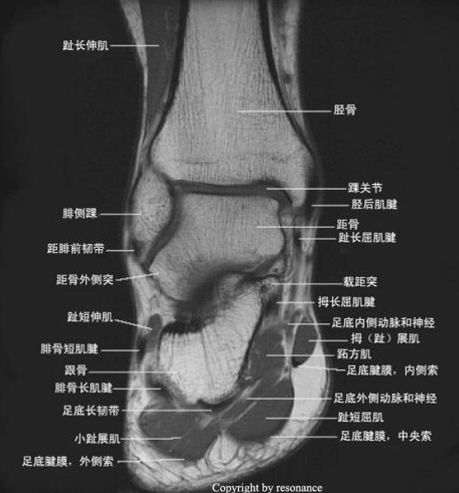 影像PPT - 踝关节MRI解剖及7种常见损伤类型影像表现-10 影像PPT - 踝关节MRI解剖及7种常见损伤类型影像表现-10