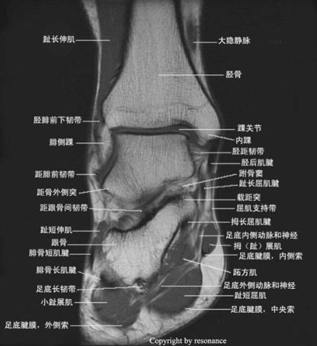 影像PPT - 踝关节MRI解剖及7种常见损伤类型影像表现-11 影像PPT - 踝关节MRI解剖及7种常见损伤类型影像表现-11