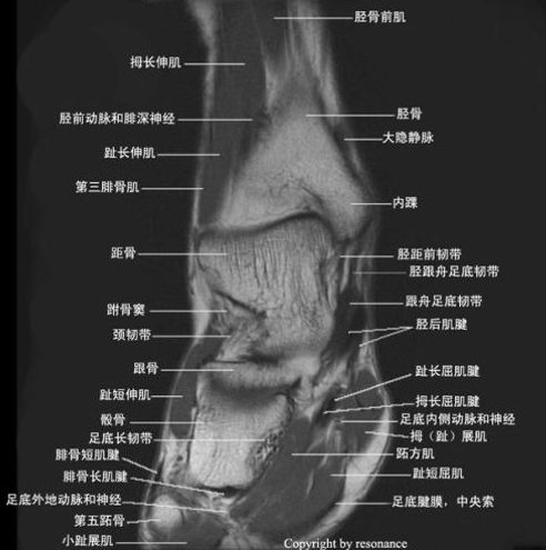 影像PPT - 踝关节MRI解剖及7种常见损伤类型影像表现-12 影像PPT - 踝关节MRI解剖及7种常见损伤类型影像表现-12